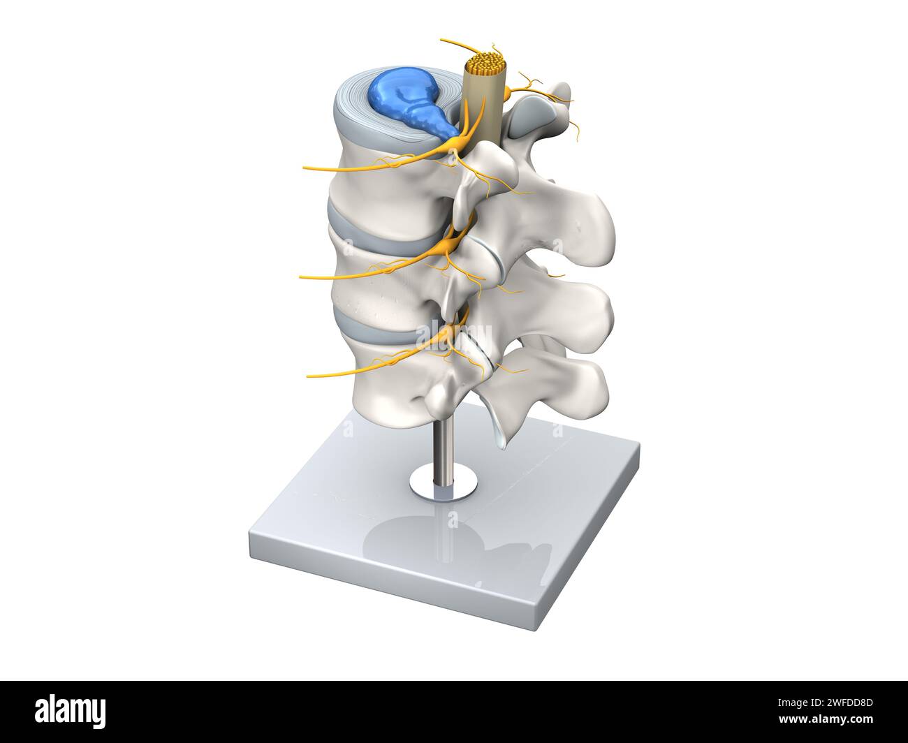 Illustration showing model of a herniated disc of the lumbar spine, stenosis, slipped disc. 3D Illustration Stock Photo