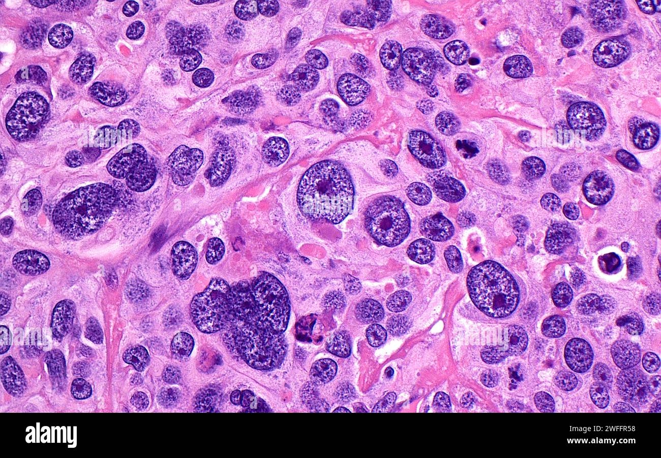 Pleomorphic cells, light micrograph Stock Photo - Alamy