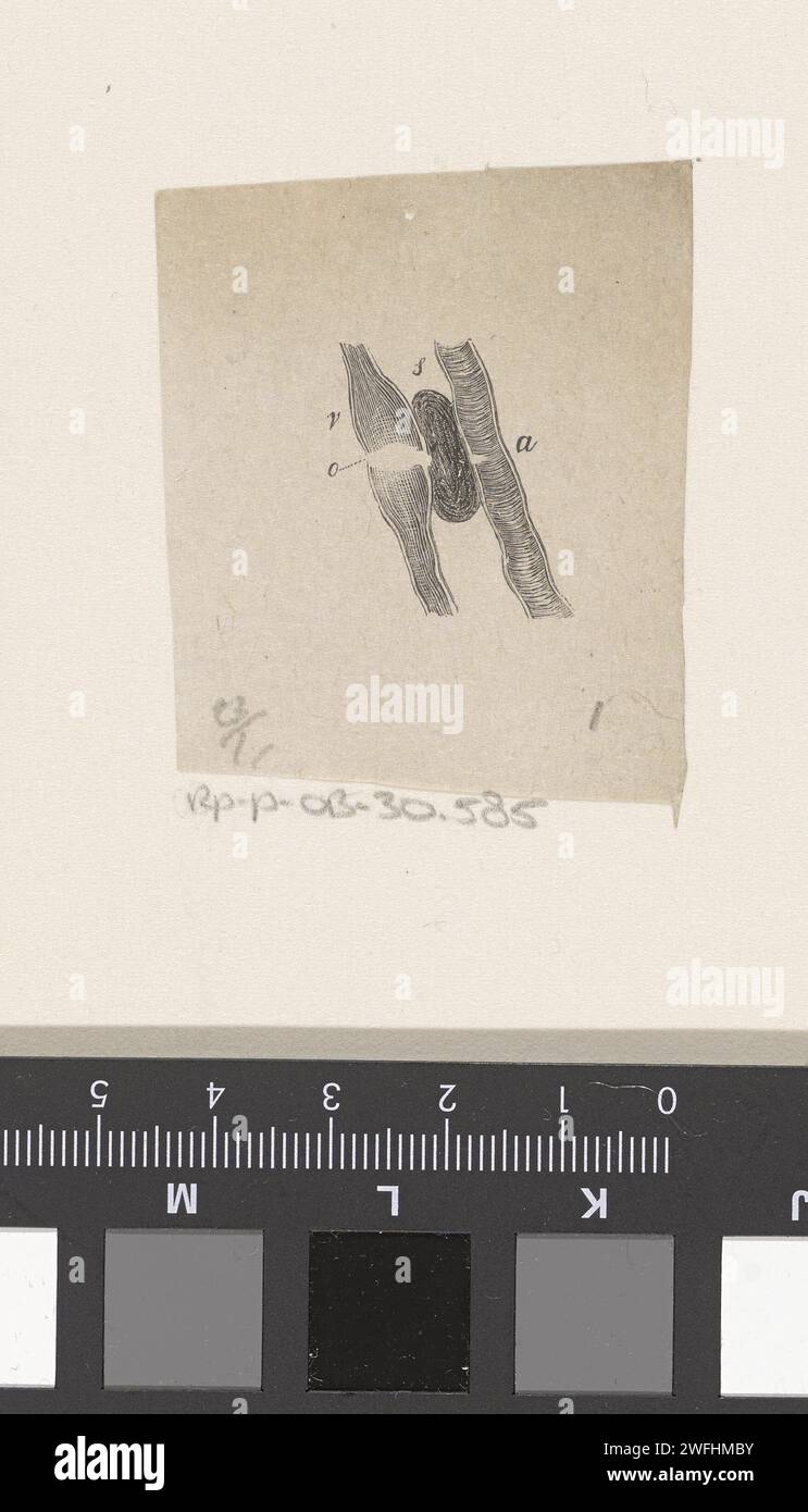 Part of the human body with a deviation, Isaac Weissenbruch, 1836 ...