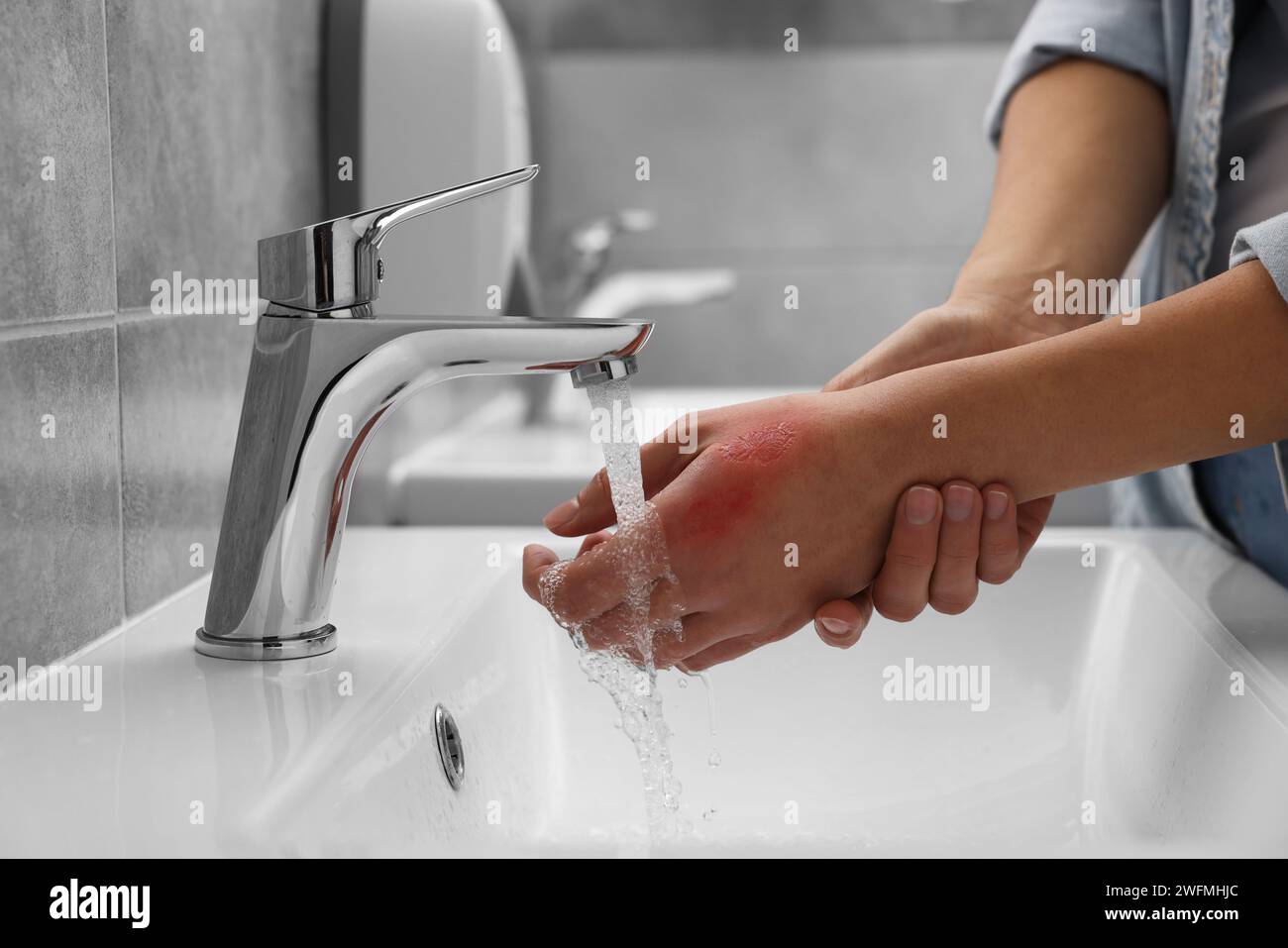 Burn skin cold water hires stock photography and images Alamy