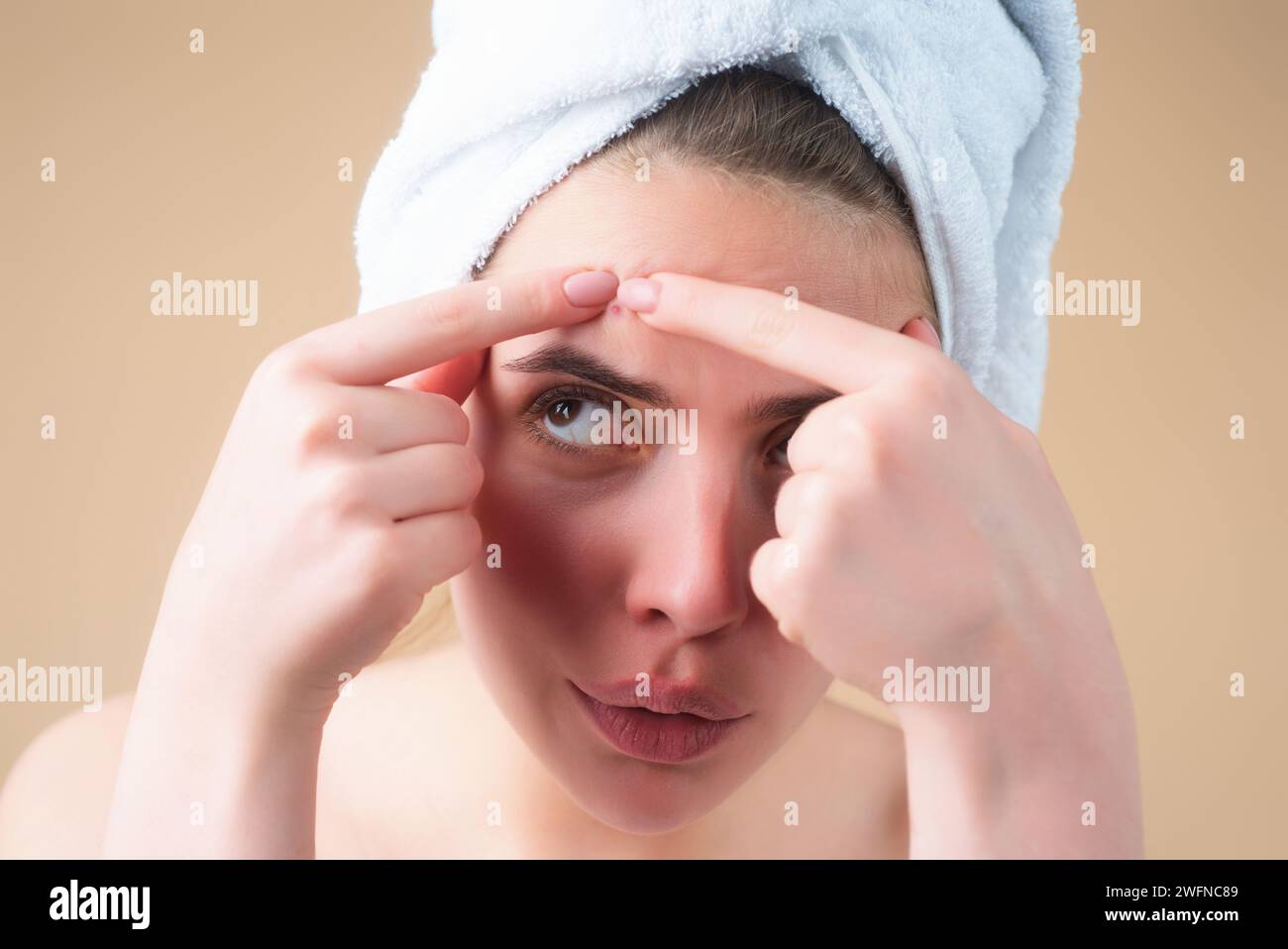 Young Woman Squeeze pimples. Girl with Acne and Pimple on Skin