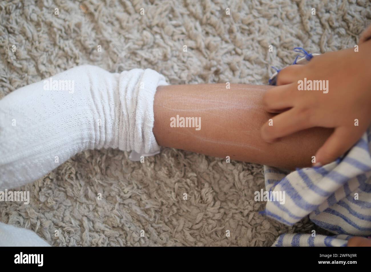 child suffering from itching skin on feet Stock Photo Alamy