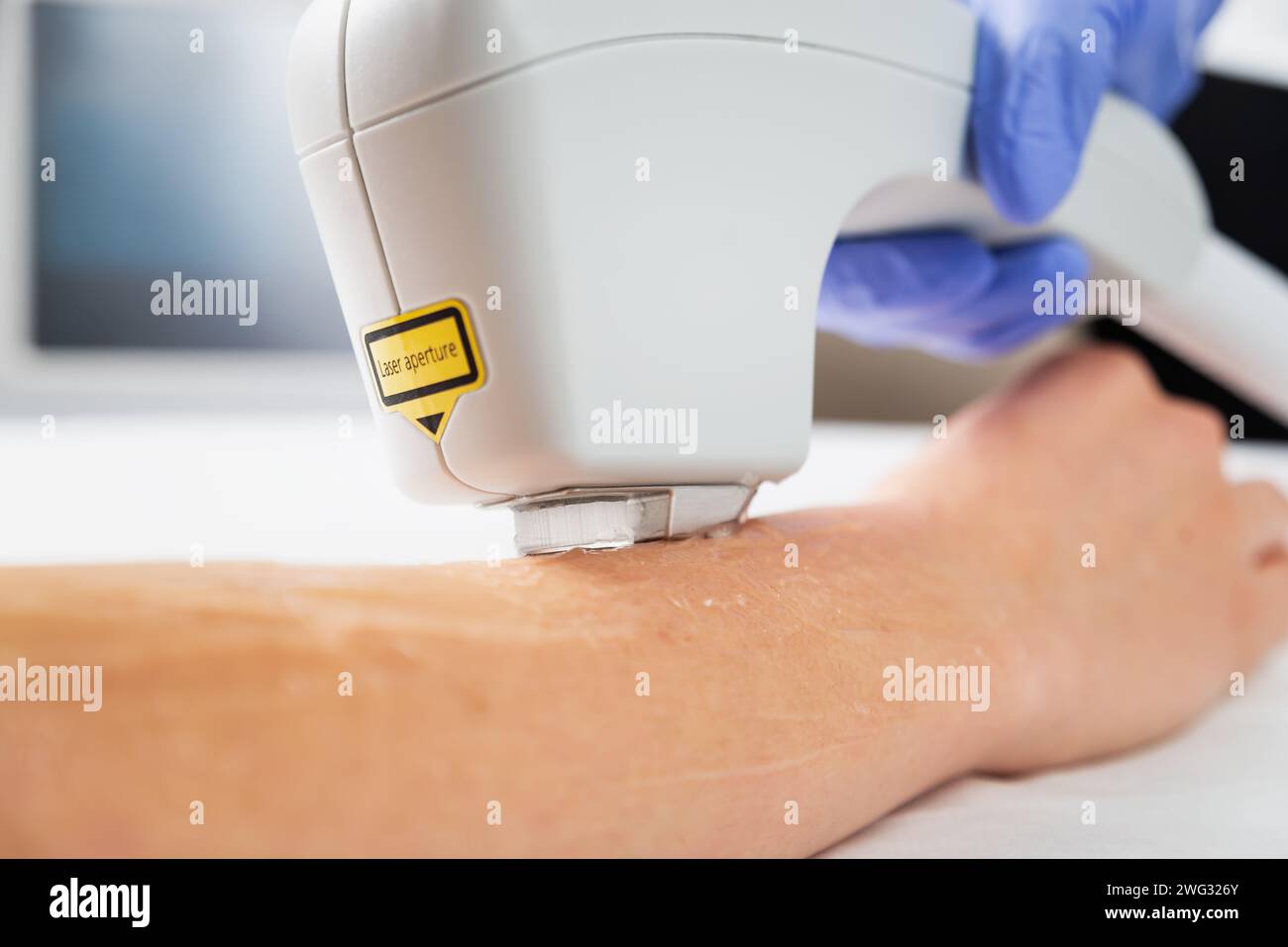Laser hair removal of hands in a beauty salon. Hand hair removal