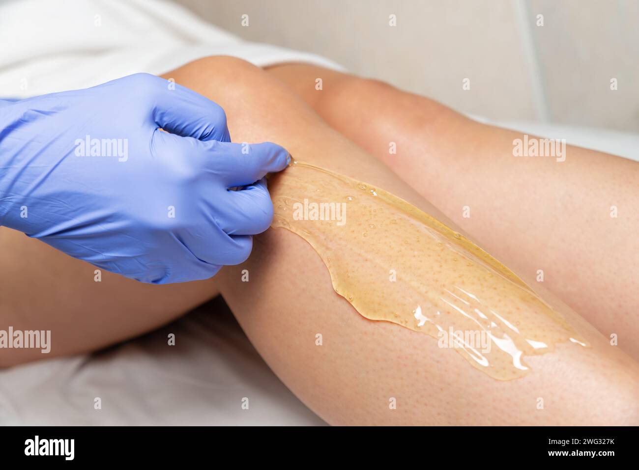 Foot sugaring procedure in a beauty salon. A gloved master applies sugar paste on a woman's leg for depilation. Stock Photo