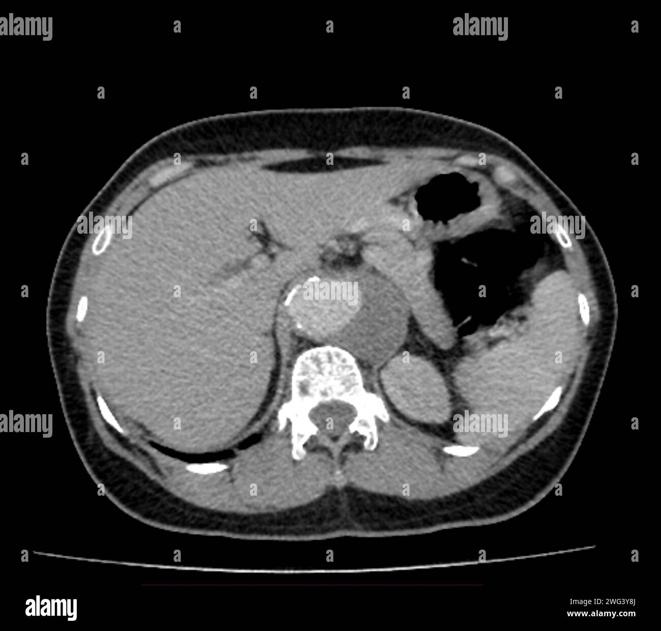 Abdominal aortic aneurysm hi-res stock photography and images - Alamy