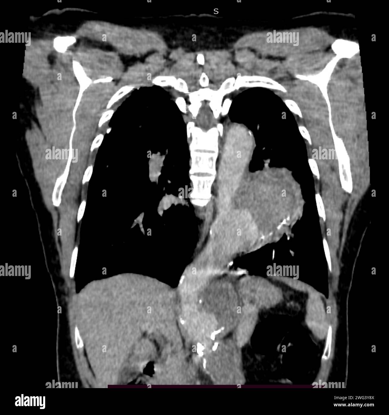 saccular-aortic-aneurysm-ct-scan-stock-photo-alamy