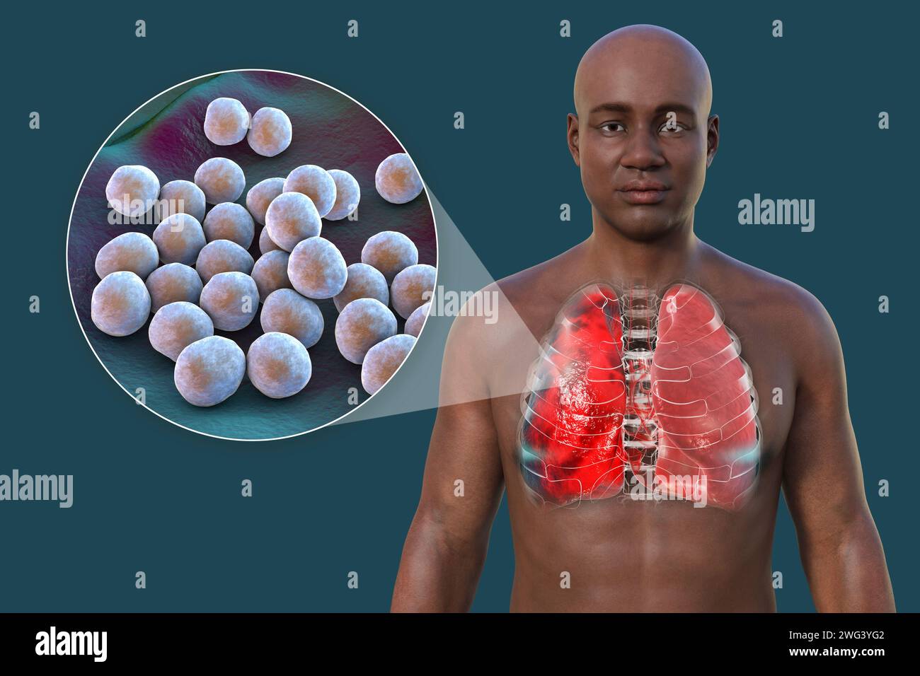 Illustration showing the upper half of a man with transparent skin, revealing the lungs affected