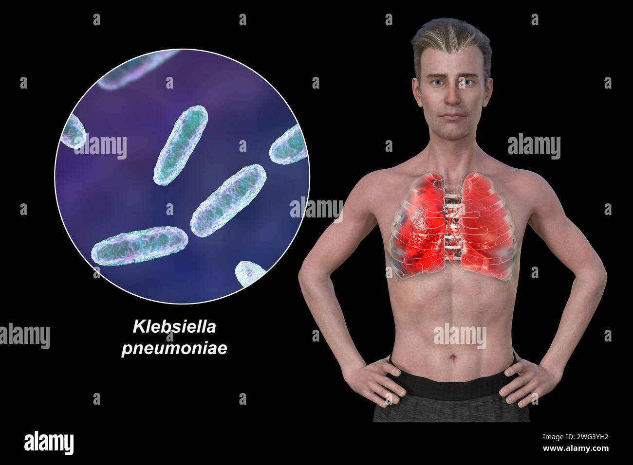 Man with lungs affected by pneumonia, illustration Stock Photo