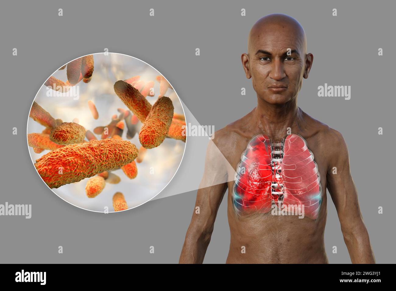 Man with lungs affected by pneumonia, illustration Stock Photo