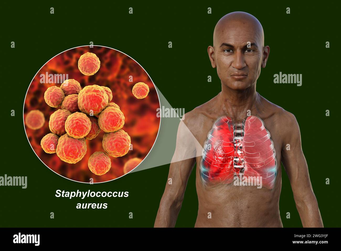 Illustration showing the upper half of a man with transparent skin, revealing the lungs affected