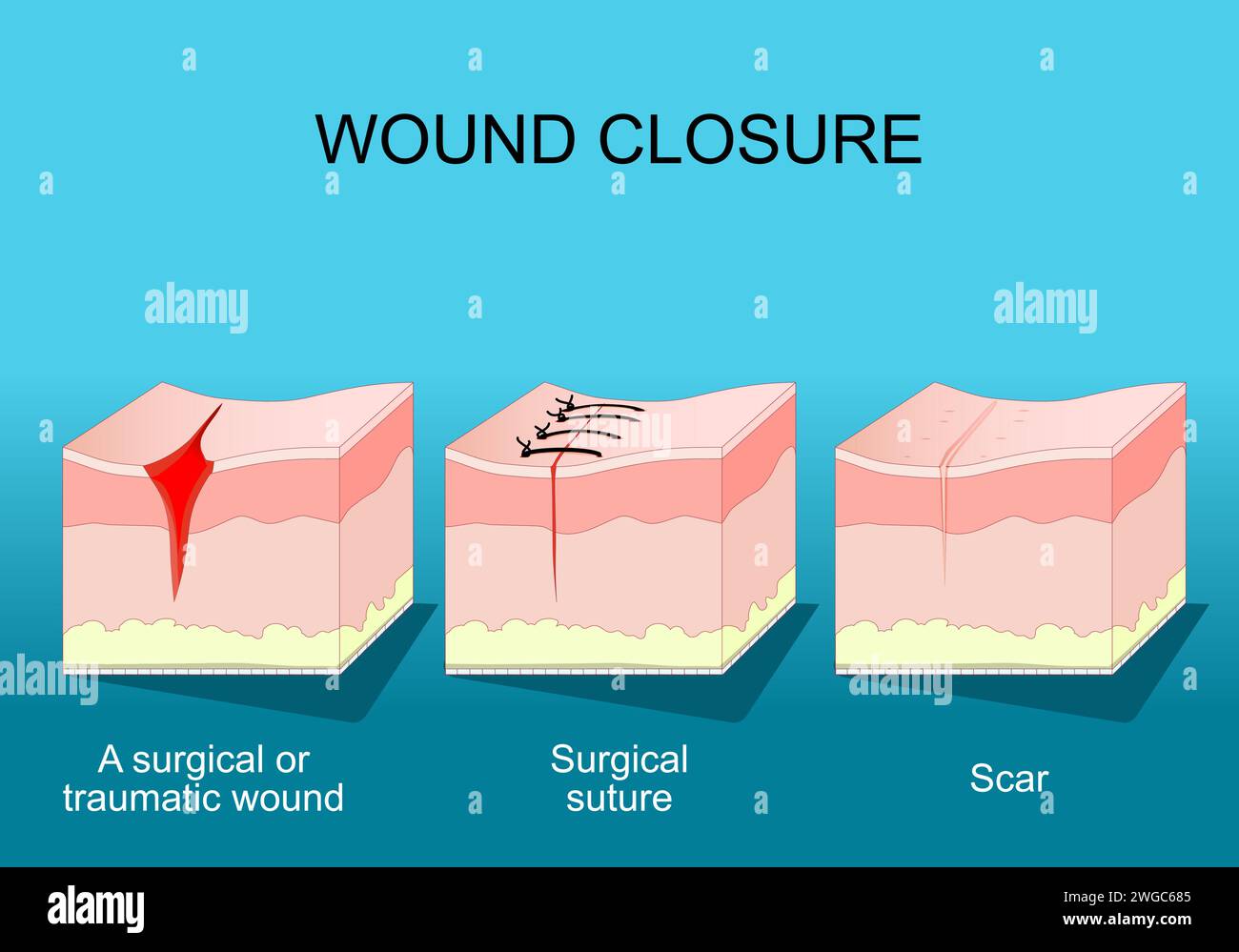 Wound healing. Skin before and after Wound Closure. From surgical or traumatic wound to suture and scar. A fibrous tissue replaces normal skin after a Stock Vector