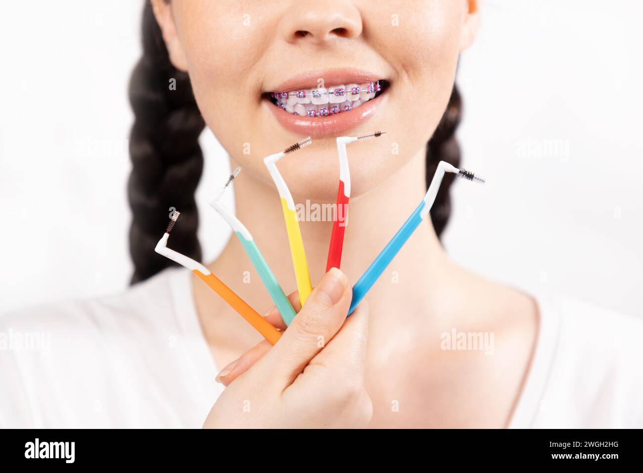 Fixed braces with ceramic brackets hi-res stock photography and images -  Alamy