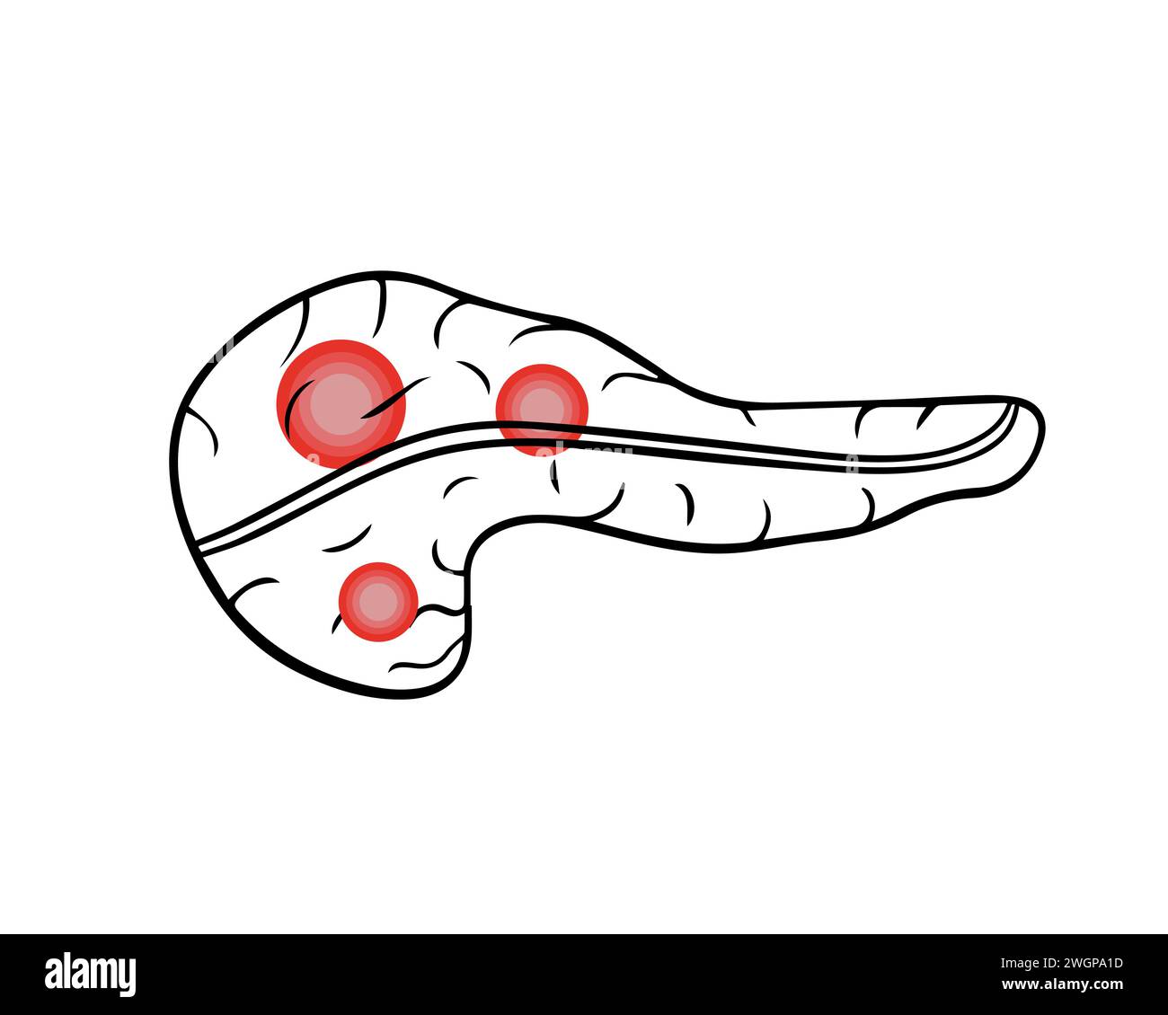 Vector isolated illustration of pancrea.Pancreatic pain. Pancreatic cancer. Stock Vector
