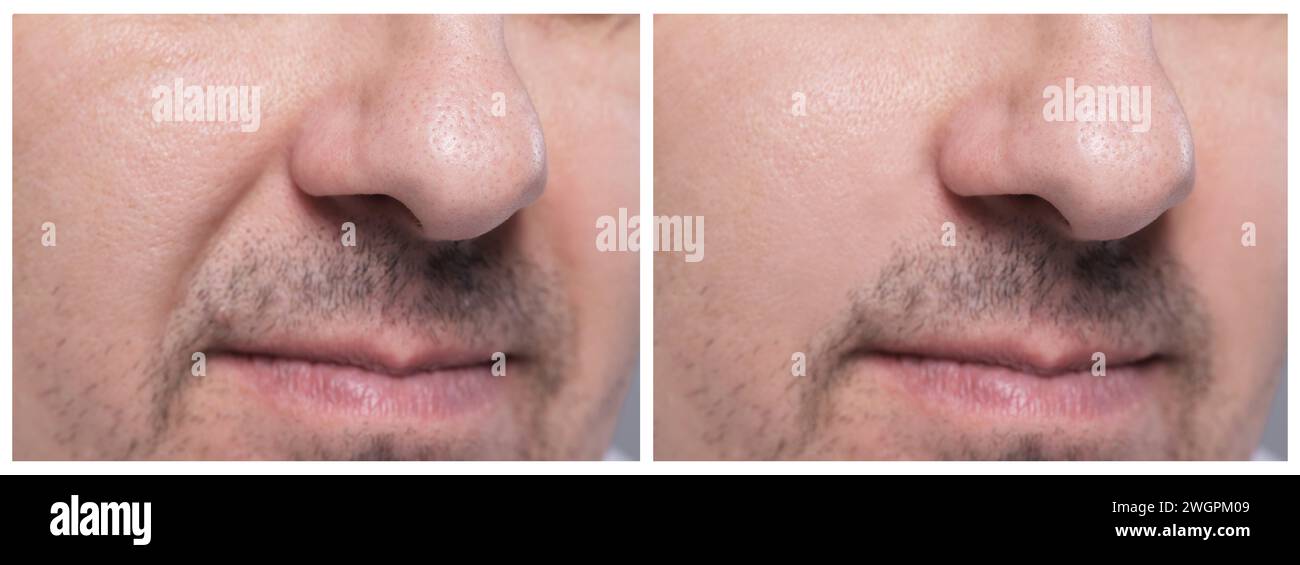 Aging skin changes. Man showing face before and after rejuvenation