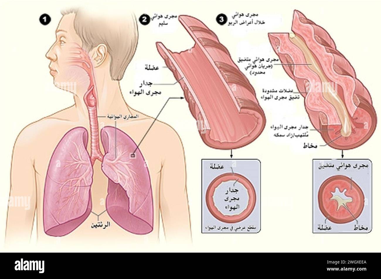 Asthma attack-illustration NIH-ar Stock Photo - Alamy