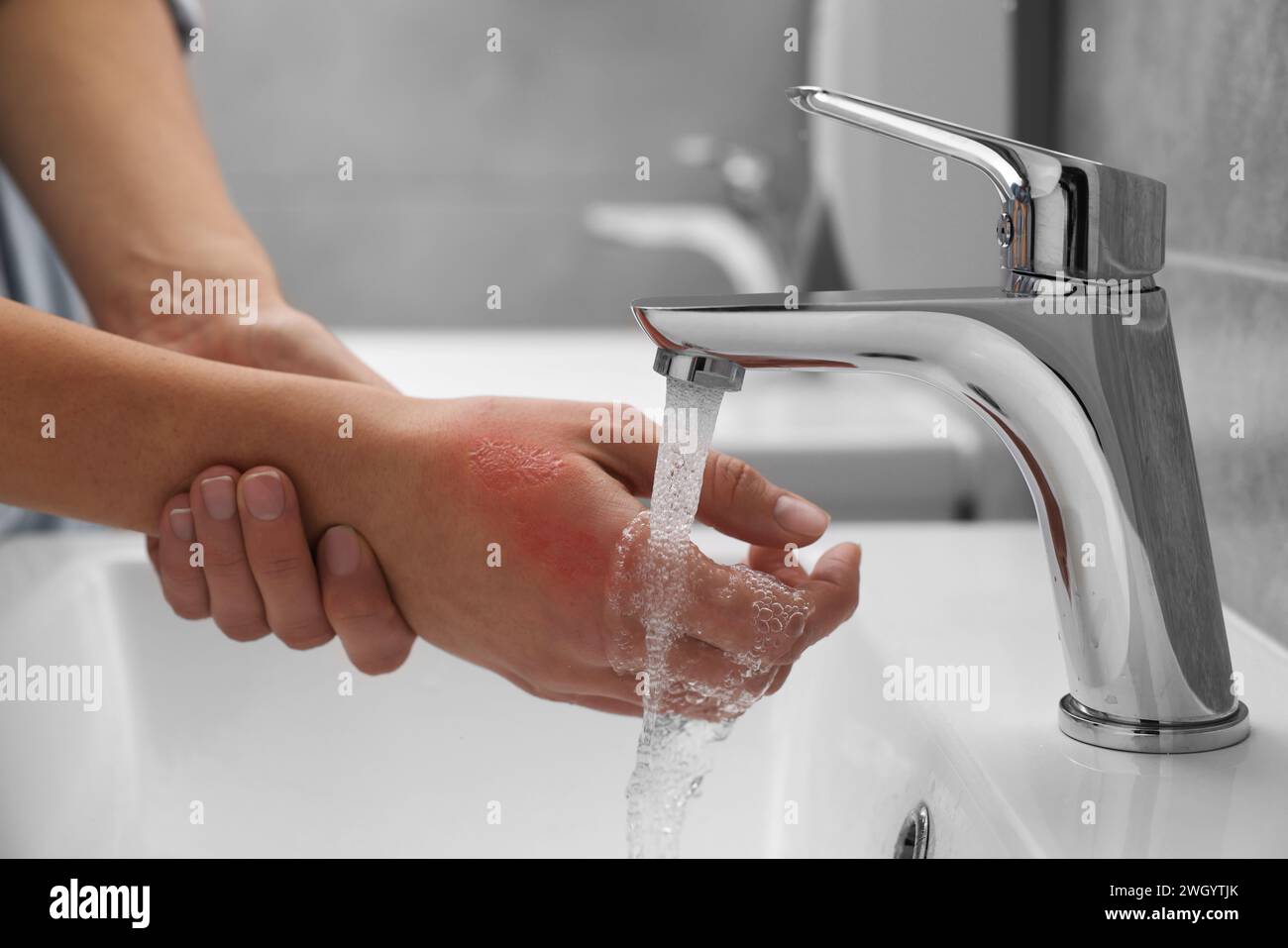 Burn skin cold water hires stock photography and images Alamy