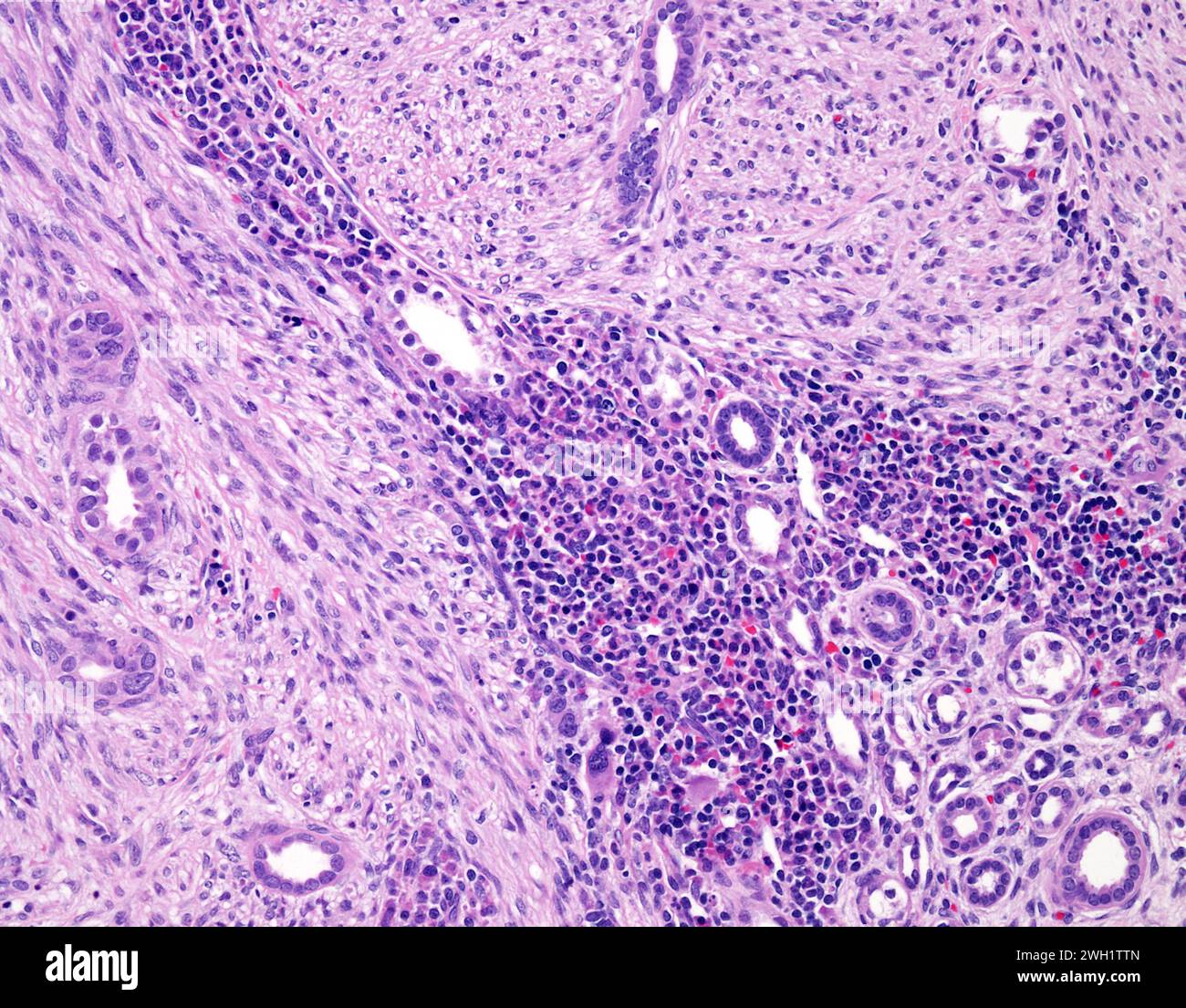 Congenital mesoblastic nephroma, light micrograph Stock Photo - Alamy