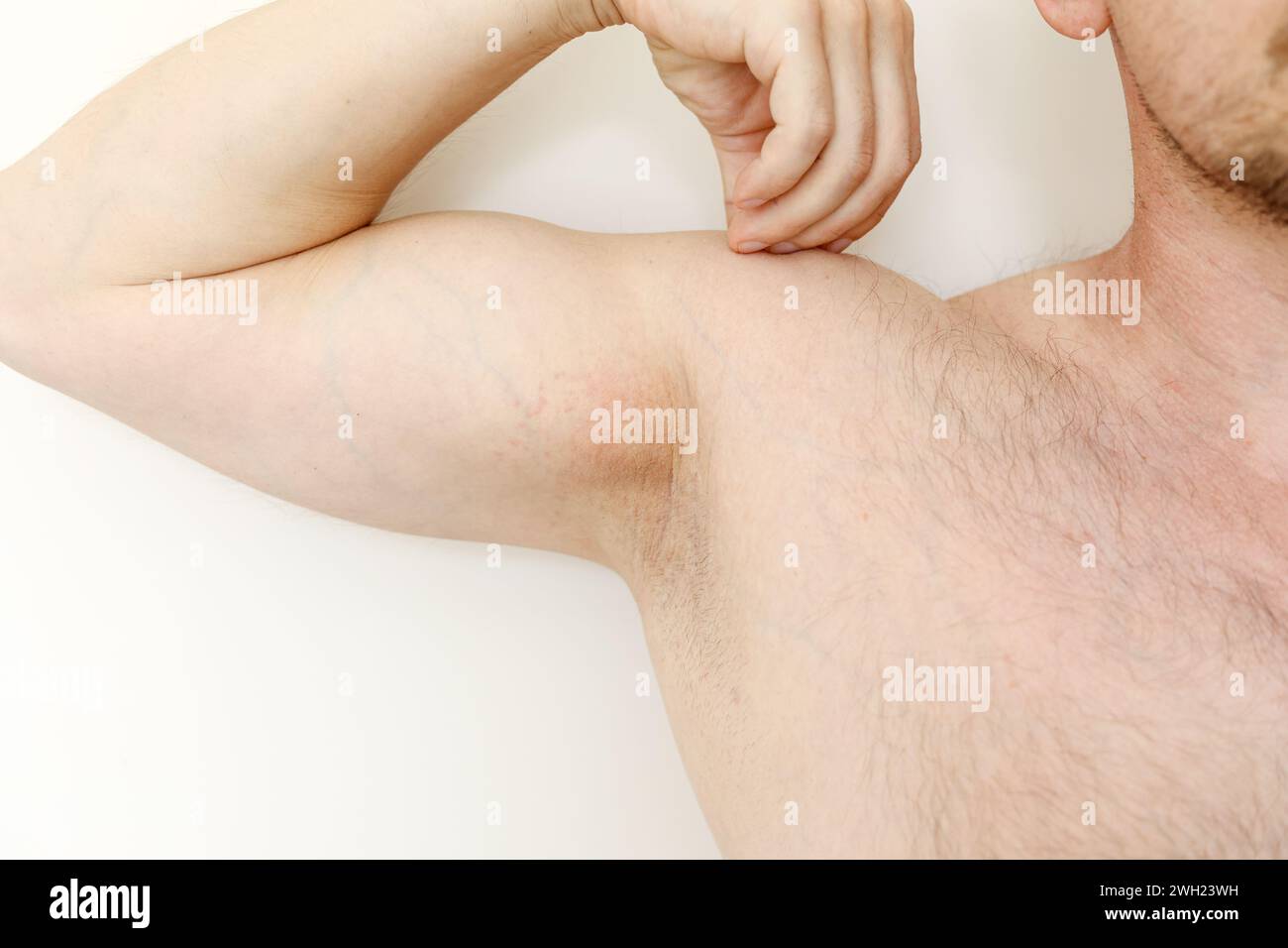 Allergy underarm. Cropped photo of irritation, inflammation on the sensitive skin after using a