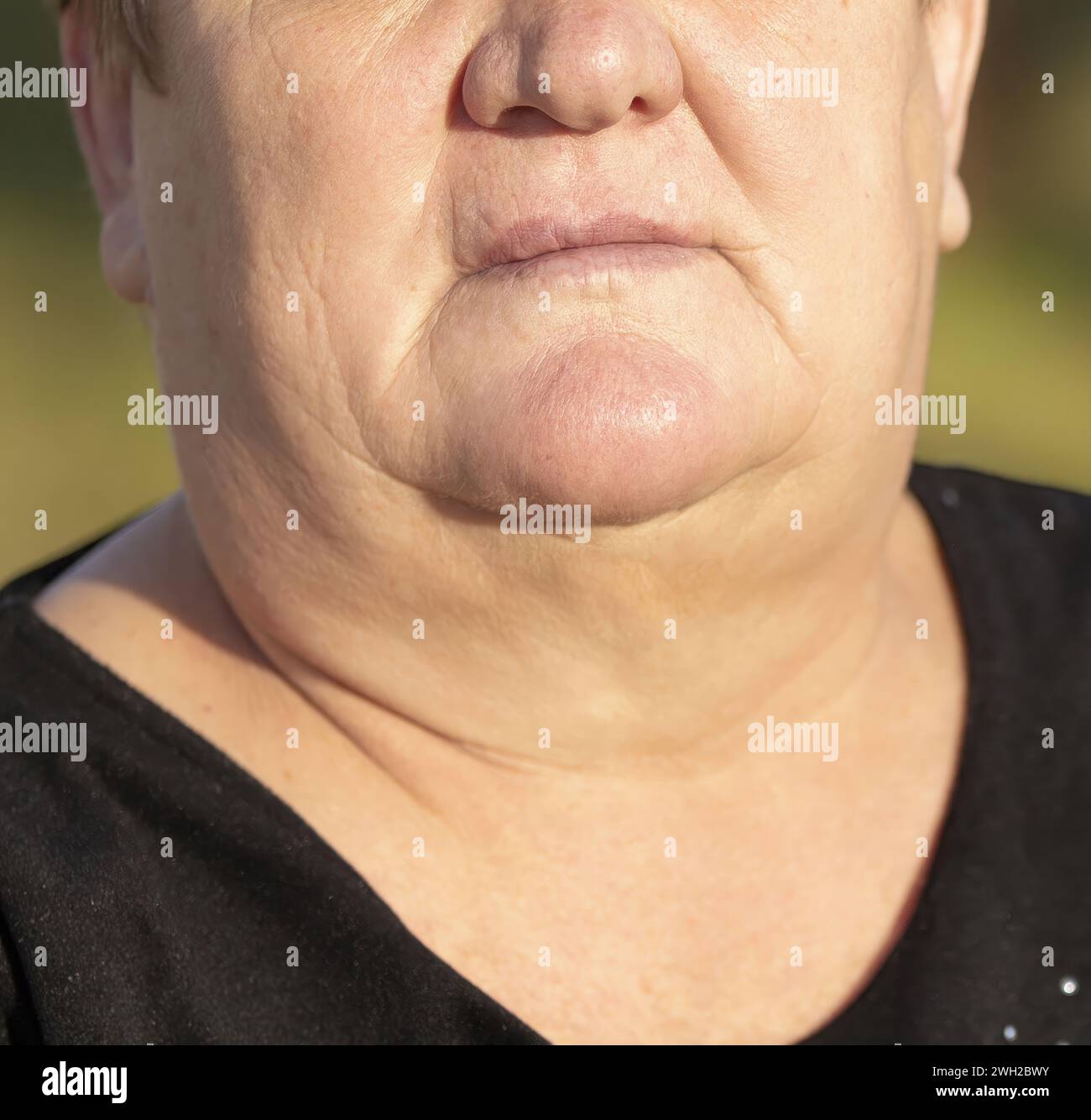 Signs of aging on the face of a plump sixtyyearold woman.Signs of