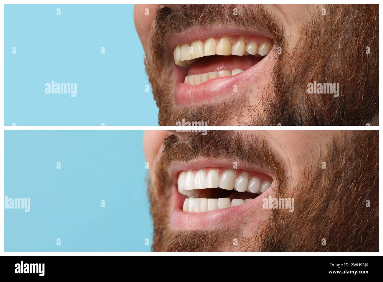 Man showing teeth before and after whitening on light blue background ...