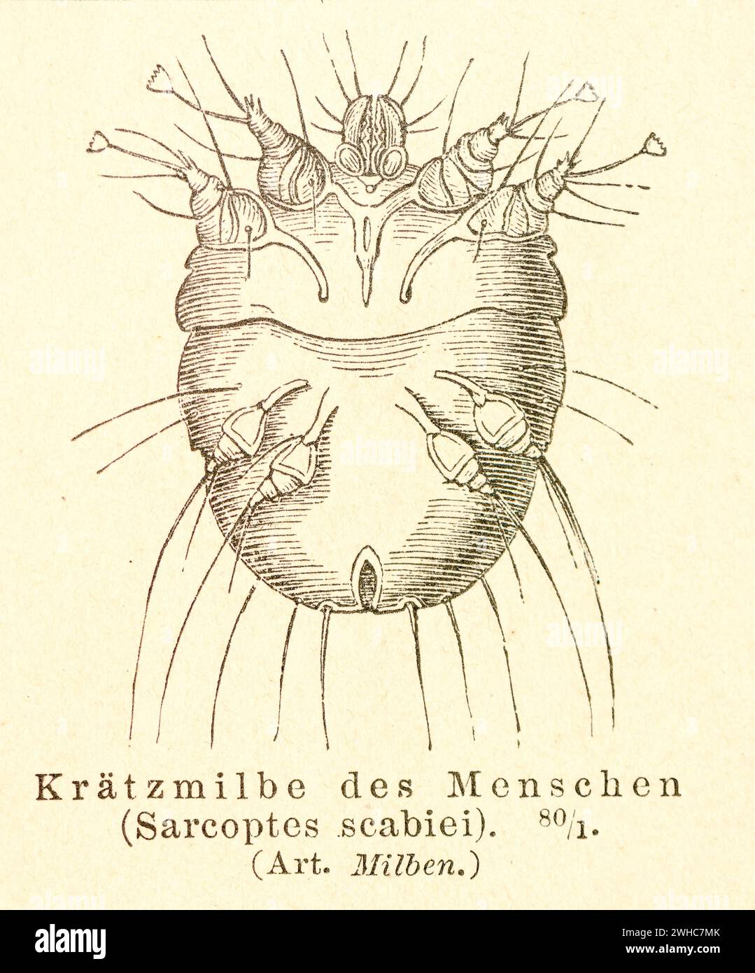 Historical wood engraving, illustration from Meyers encyclopedia 4th edition 1889 and 1890, scabies mite (Sarcoptes scabiei) or grave mite or scabies Stock Photo