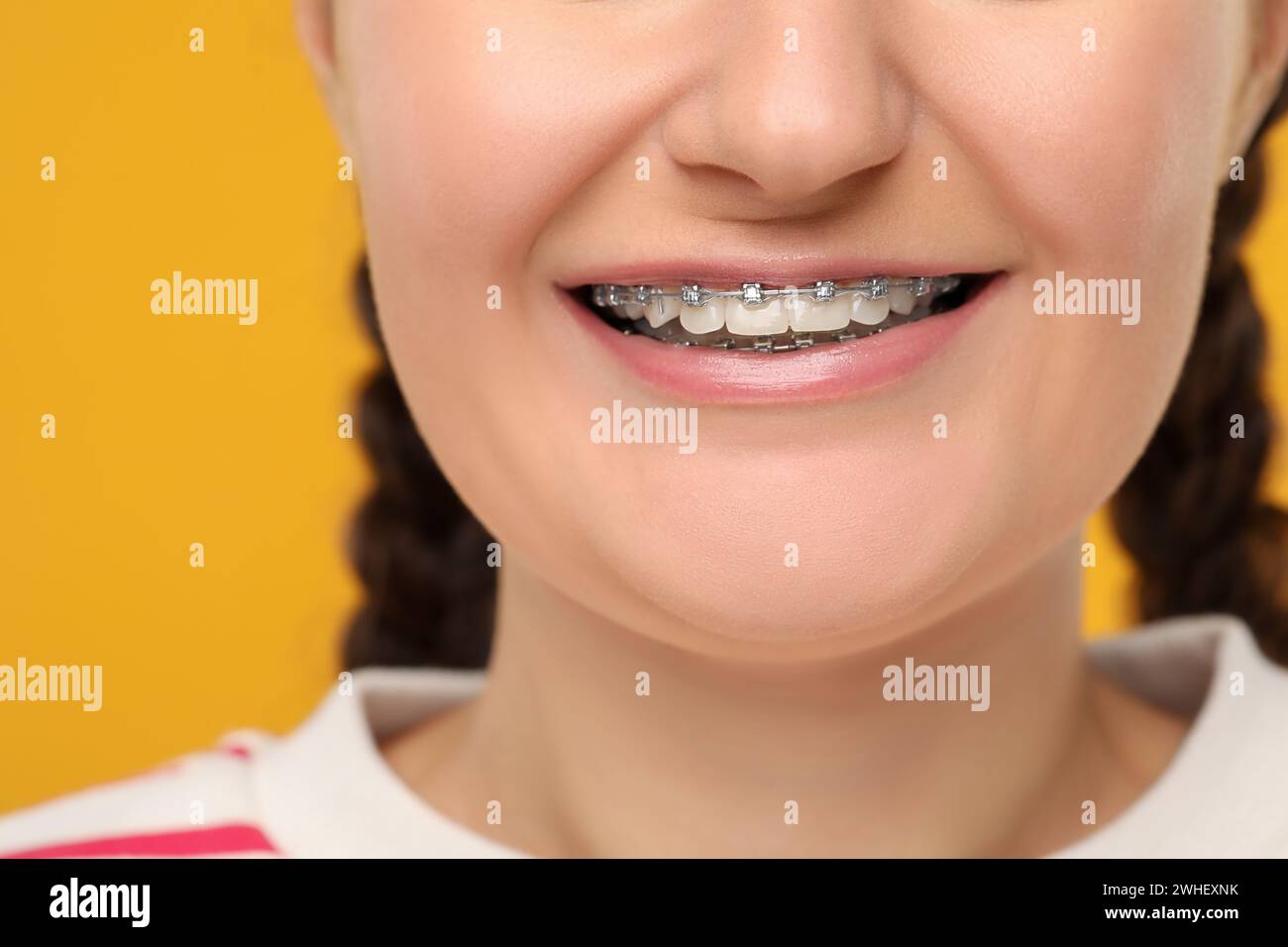 Adult braces open mouth hi-res stock photography and images - Page 2 - Alamy