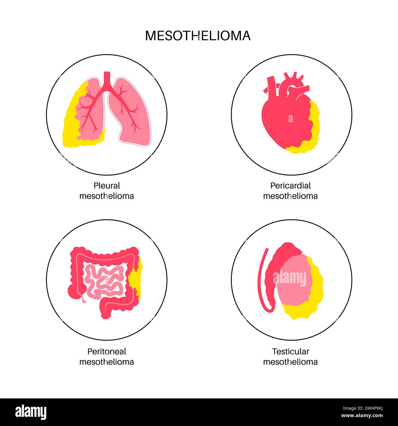 Amazing 4 Types Of Mesothelioma Artwork Concept Amazing 4 Types Of Mesothelioma Artwork Concept