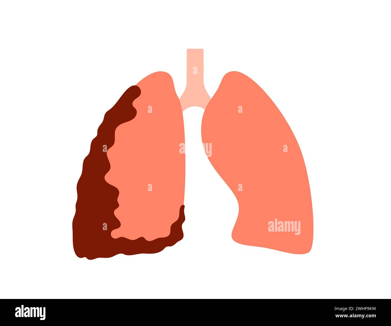 Pleural cancer hires stock photography and images Alamy