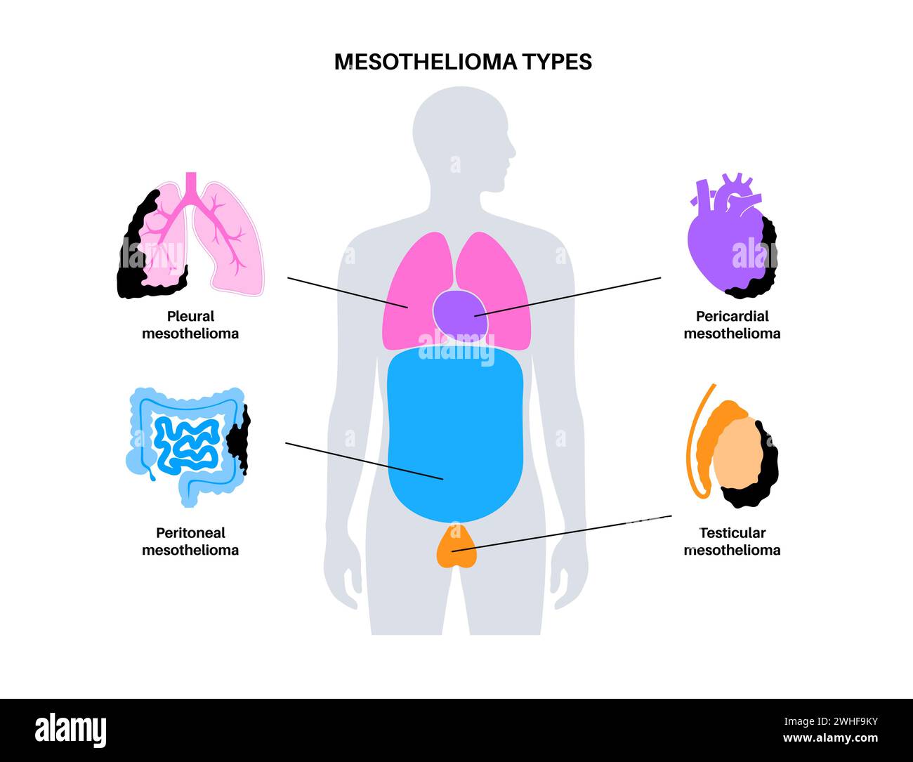 Breathtaking 2 Types Of Mesothelioma Wallpaper Digital Art Breathtaking 2 Types Of Mesothelioma Wallpaper Digital Art