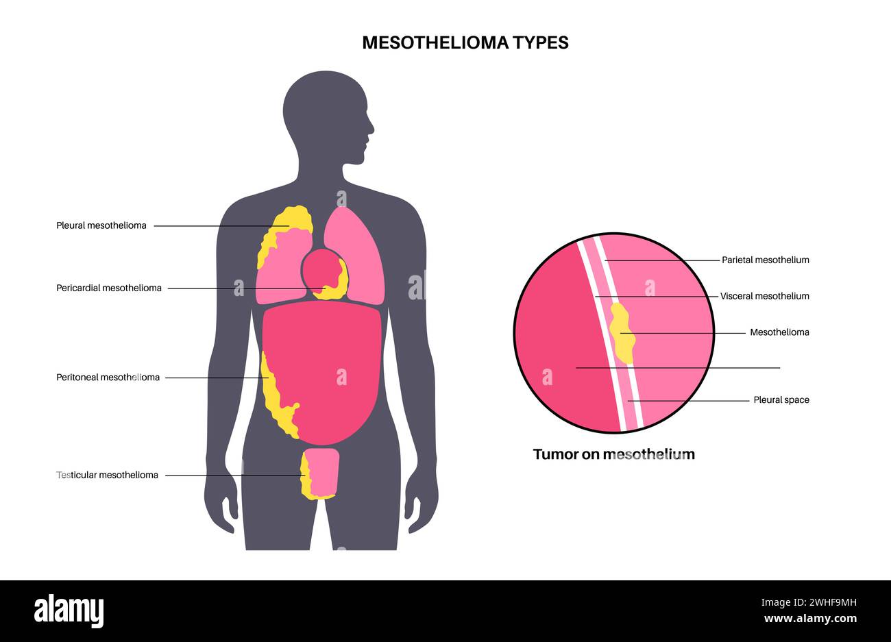 Mesothelioma tumour types, illustration Stock Photo