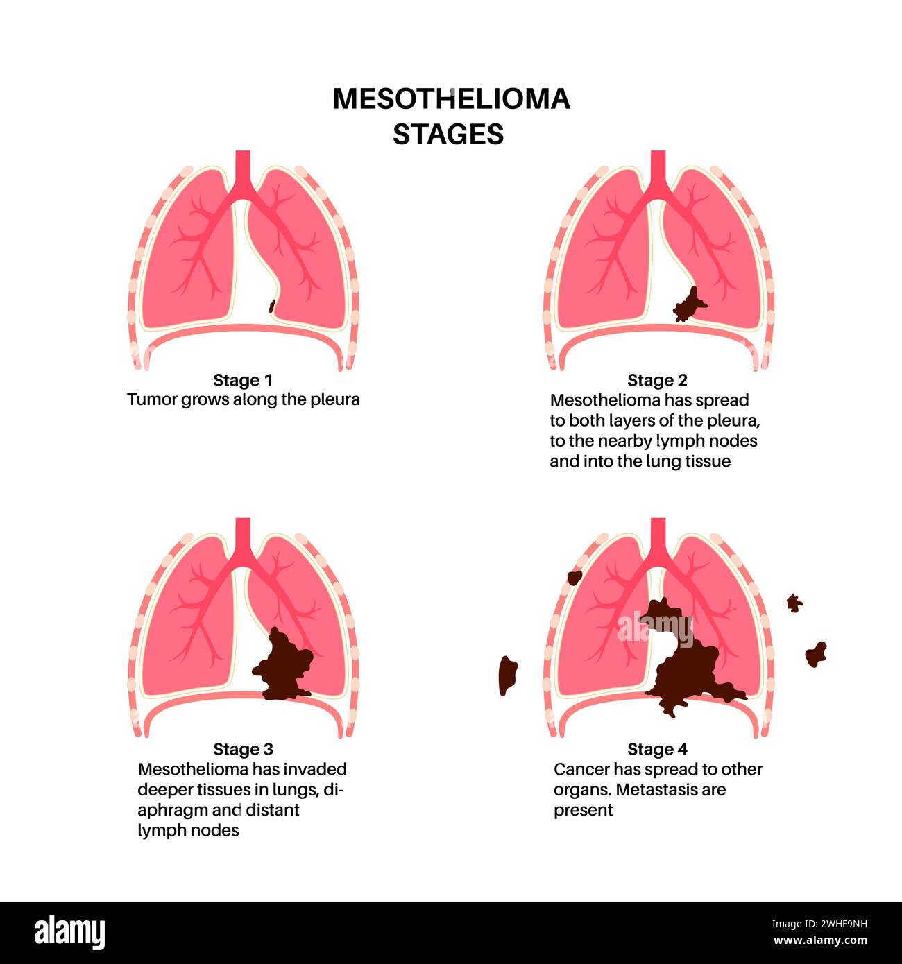 Mesmerizing Mesothelioma Cancer Stage 2 Treatment Wallpaper for Your Screen Mesmerizing Mesothelioma Cancer Stage 2 Treatment Wallpaper for Your Screen