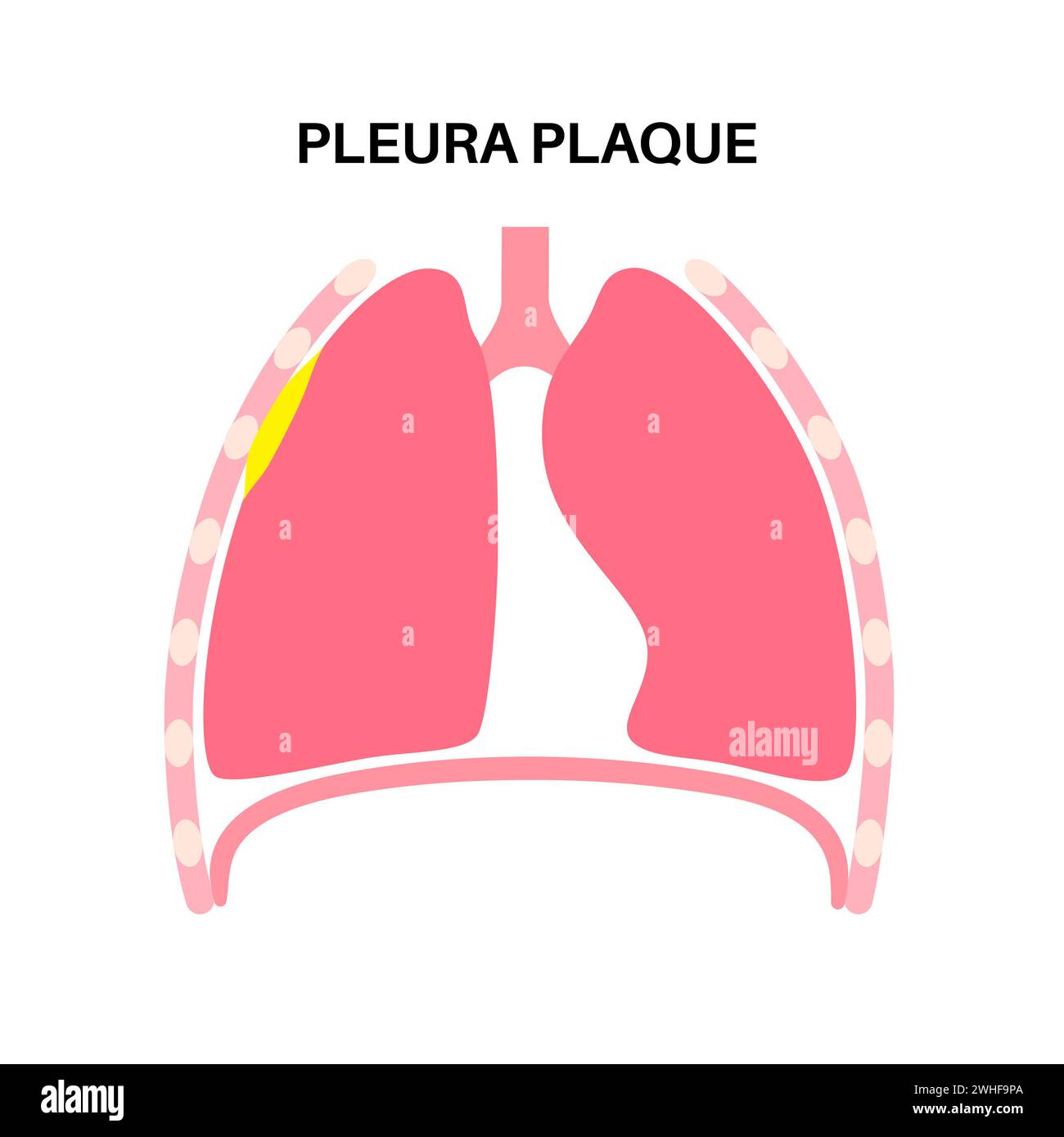 Pleural plaque, illustration Stock Photo - Alamy