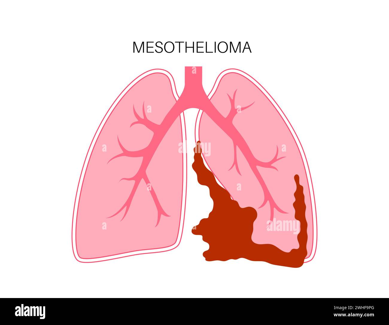 Gorgeous Que Es Mesothelioma Cancer Photo Photography Gorgeous Que Es Mesothelioma Cancer Photo Photography