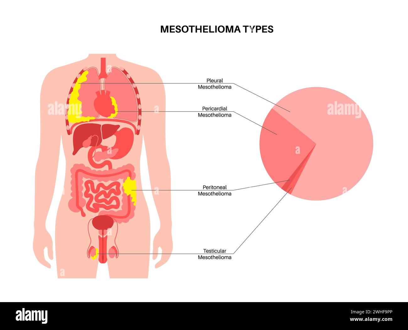 Mesothelioma tumour types, illustration Stock Photo
