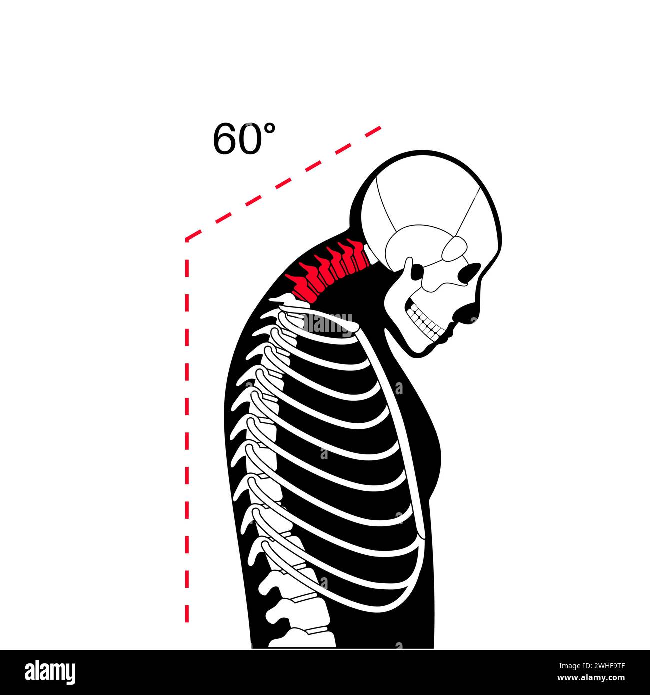 Neck vertebrae deformity, illustration Stock Photo
