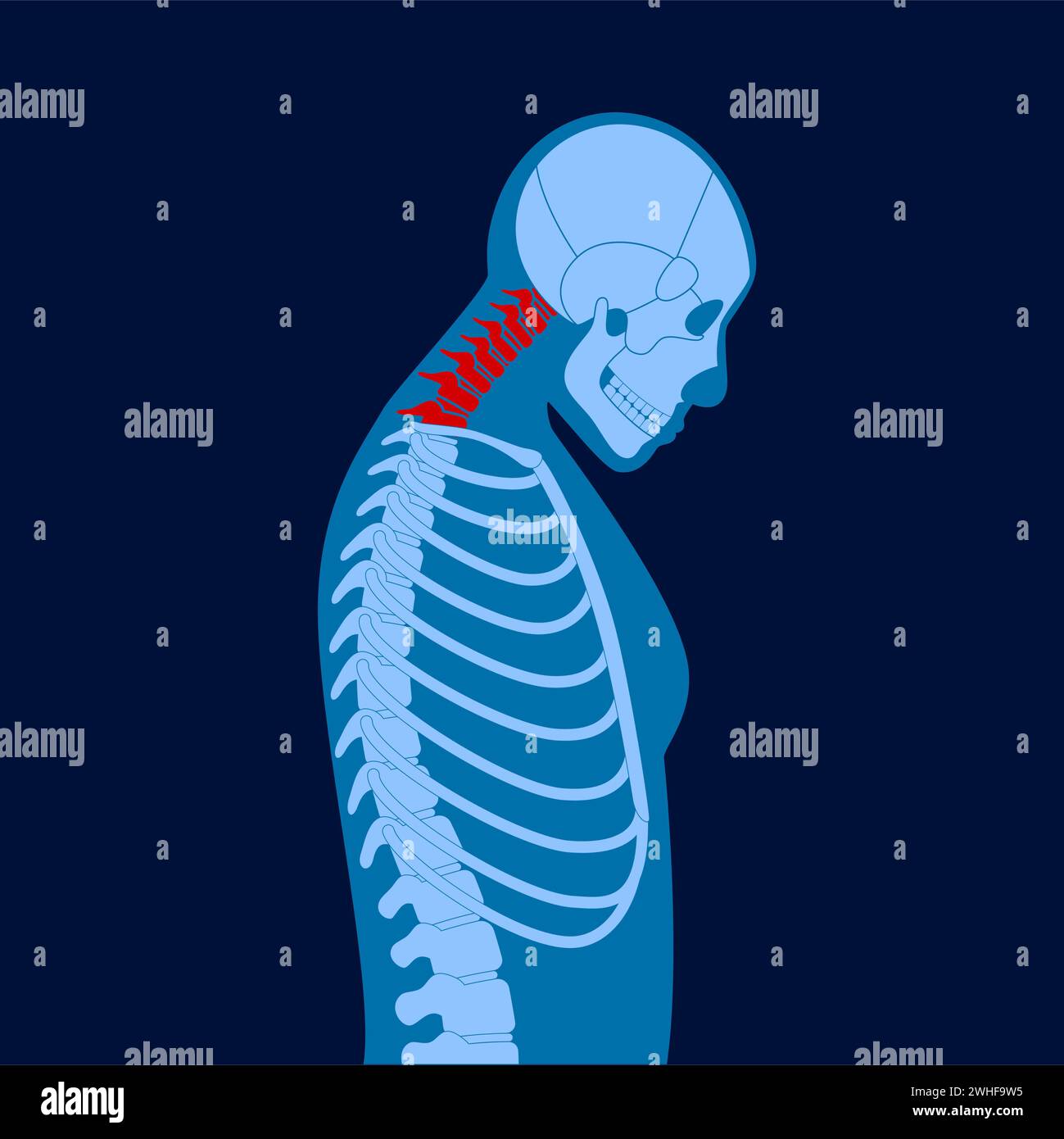 Neck vertebrae deformity, illustration Stock Photo Alamy