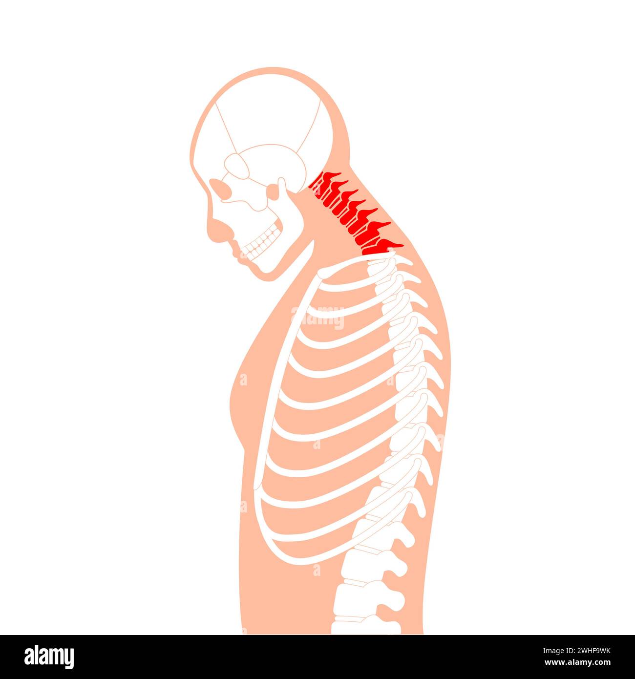 Neck vertebrae deformity, illustration Stock Photo - Alamy
