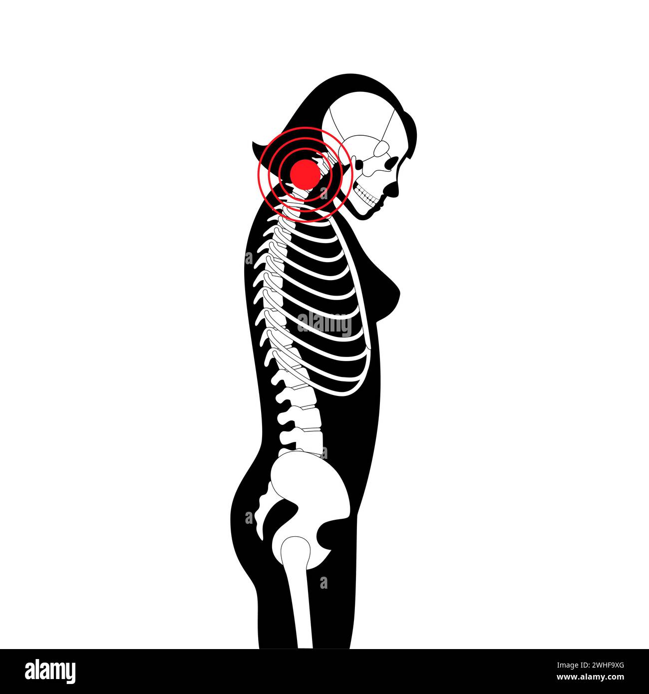 Neck vertebrae deformity, illustration Stock Photo