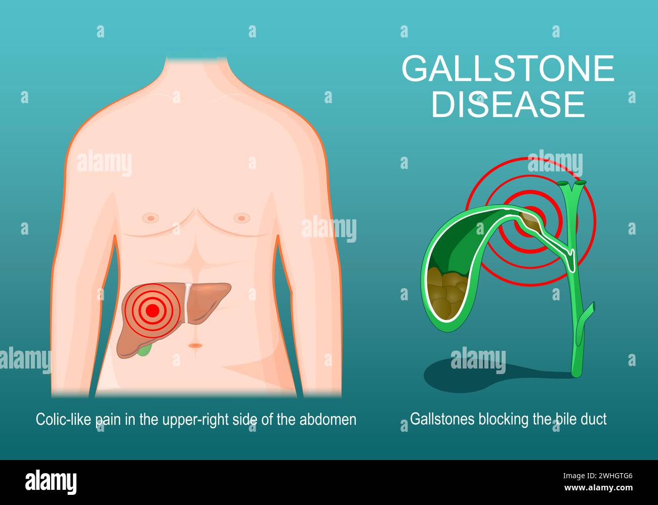 gallstone disease. Human body with liver. Cross section of Gallbladder with Gallstones that blocking of a bile duct. Symptoms of cholelithiasis. Isome Stock Vector