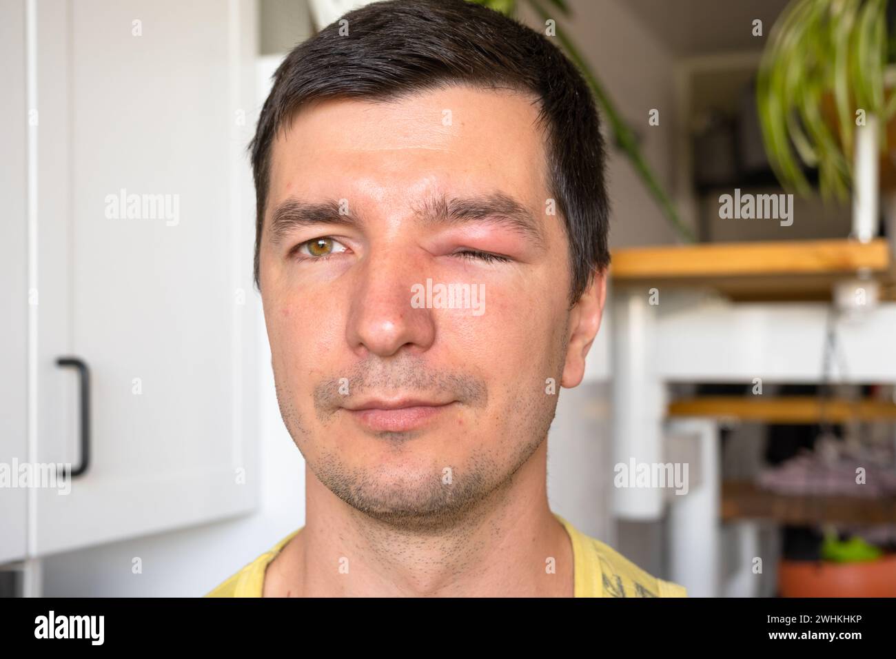 A red swollen eyelid on a man's face in close-up is an allergy to an insect bite. Allergic reaction to blood-sucking insects Stock Photo