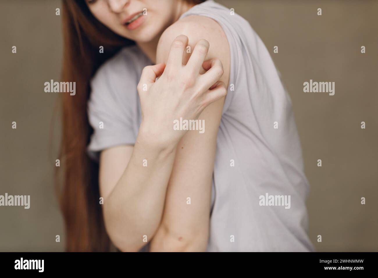 Allergy dermatology scabies itches skin problem woman Stock Photo