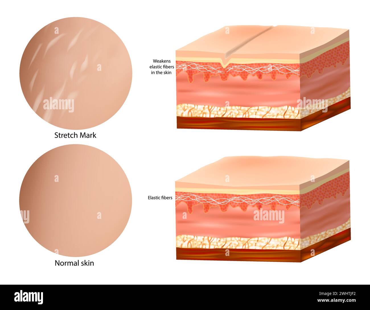 Medical Anatomy Skin Stretch Marks. Normal skin and Stretch Mark