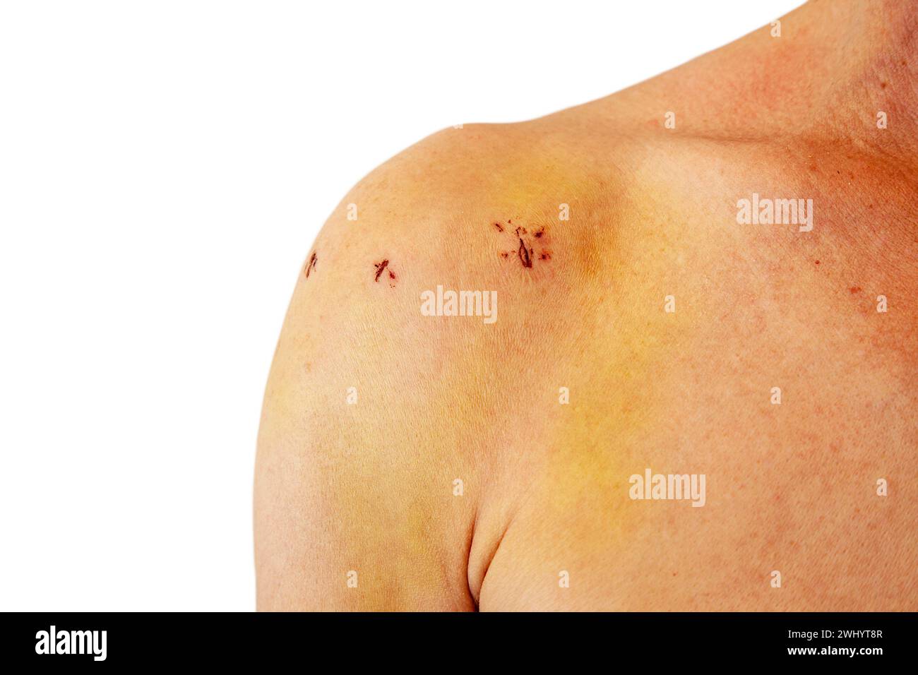 Male shoulder with scars after shoulder Arthroscope surgery. Chronic dislocation of the long biceps Stock Photo