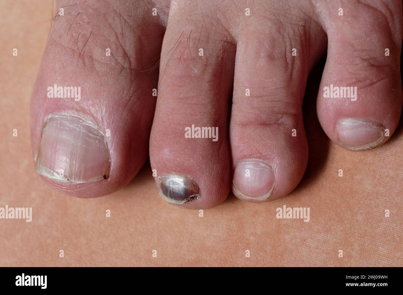 blood pooling under a toe nail causes it to look black 2WJ09WH