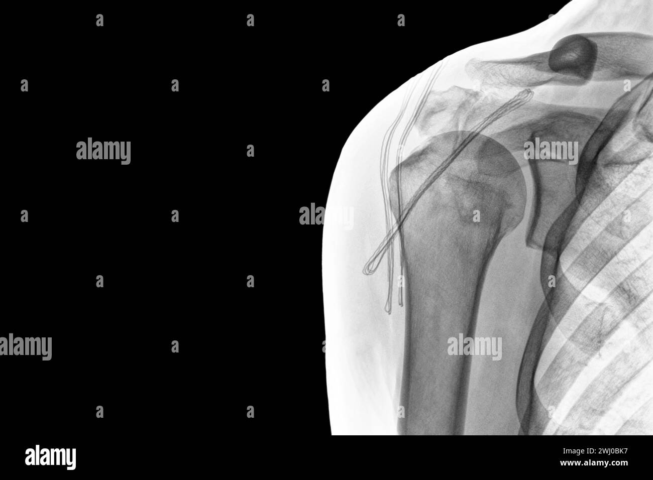 X-ray of a luminous of shoulder isolated on black background. Chronic dislocation of the biceps Stock Photo