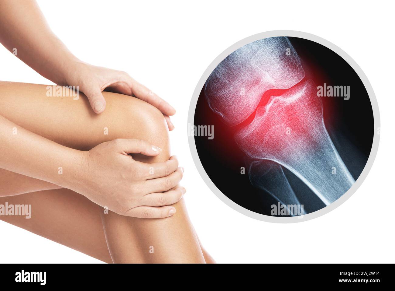 Knee and and X-ray effect with an injured joint Stock Photo