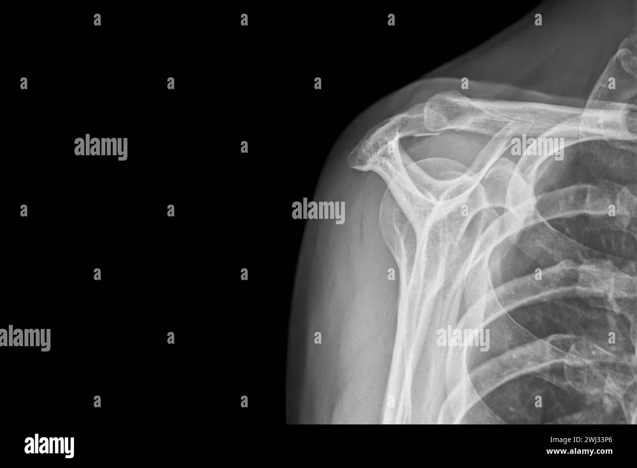 X-ray of a luminous of shoulder isolated on black background. Chronic dislocation of the long biceps Stock Photo