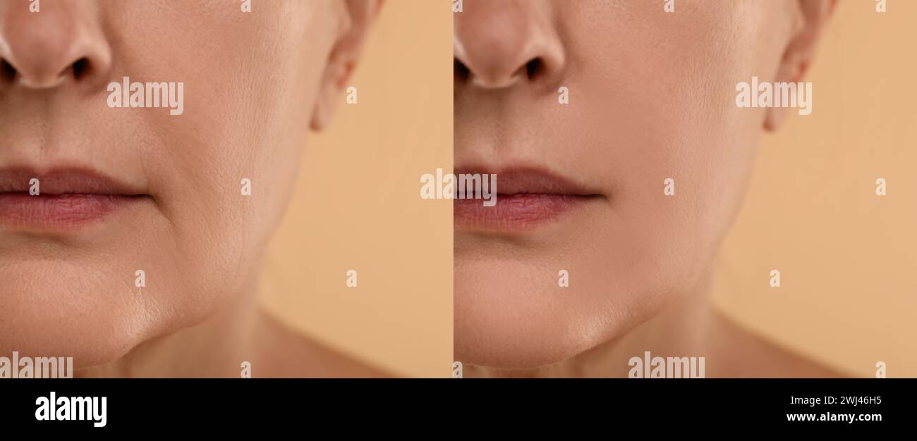 Aging skin changes. Woman showing face before and after rejuvenation, closeup. Collage comparing skin condition Stock Photo