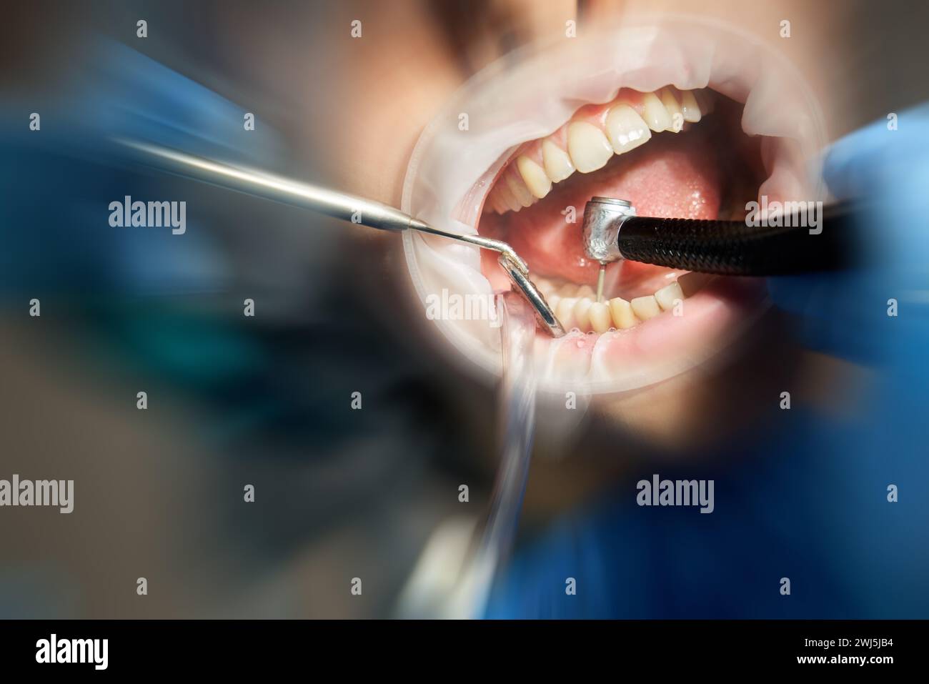 Dentist drilling tooth to male patient in dental chair with motion blur effect Stock Photo