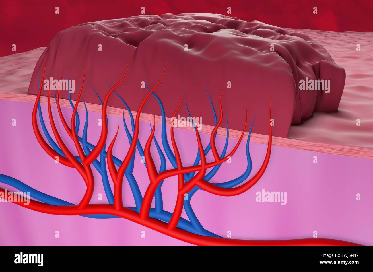 Hemangioma tumor - closeup view 3d illustration Stock Photo